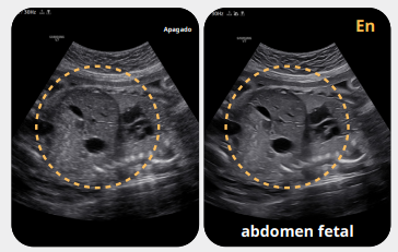 abdomenfetal