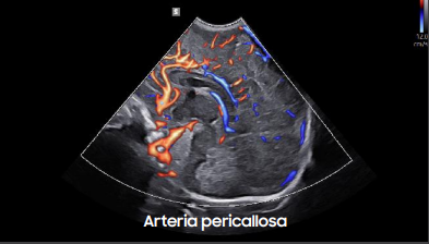 arteriapericallosa