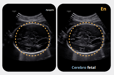 cerebrofetal