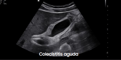 colecititis