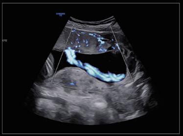 cordonumbilicalconmvflow