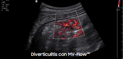 diverticulitis