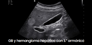 gbhemangioma