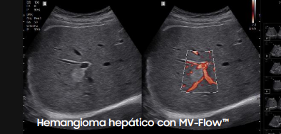 hemangioma