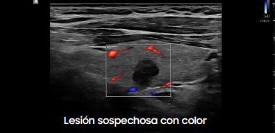 lesionsospechosa