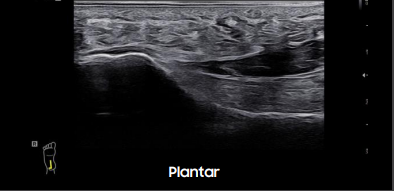 plantar