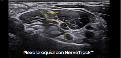 plexobraquial