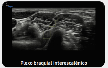 plexobraquialv7gi