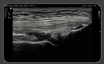 suprapatellartendon