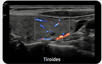 tiroides