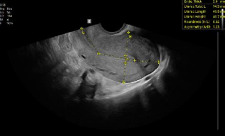 uterineassis