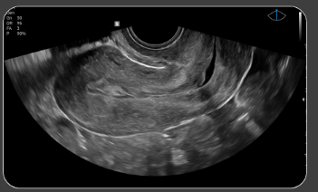 uteruspolyp